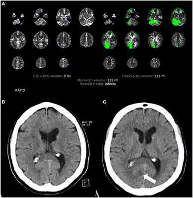 IV-Thrombolysis in Ischemic Stroke With Unknown Time of Onset—Safety and Outcomes in Posterior vs. Anterior Circulation Stroke